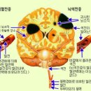 뇌혈관질환과 치매의 연관성 이미지