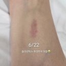 바른애드 | 팔 화상 흉터 한 달 경과 후기｜비타민·미백크림·흉터연고·선크림 꾸준히 바른 결과