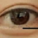 [2017.02.13][부분절개쌍수재수술,눈매교정,듀얼트임(뒷,밑),눈밑지방재거,눈밑자가지방이식] [7일째][여자] 이미지