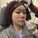 가락시장역 | [ 가락시장역피부과 ] 온다리프팅 내돈내산 후기(가격, 효과, 전후 비교)