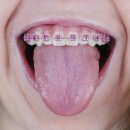 유디부평치과의원 네이버블로그
