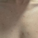 인천한의원 | 가드름 흉터 율각테라피 인천한의원 내돈내산 후기