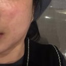 장산약국 | 장산역 피부과 리쥬란 힐러로 피부장벽 되살리기 (내돈내산 후기)