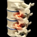 연세힐링재활의학과의원 | 요추 후관절 증후군(Facet Joint Syndrome) - 서울역 / 남대문 / 중구 / 재활의학과 / 정형외과