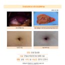 만성담낭염수술후기. 원장님이 친절하시고 수술경력도 많으시며 하루만 입원하면 되고 통증이 크지않아... 이미지