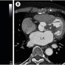 Rare Cause of Exertional Angina 이미지