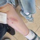 한강수병원 | 영등포 한강수병원 어린이 흉터치료 후기 (담당의 송우진 원장)