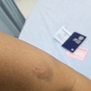 대성인터내셔널동물약품 | [태국 파타야] 원숭이 물림사고 후기 | 현지병원, 국내병원 공수병 백신