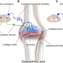 관절 통증 이해의 확장.. subchondral bone pain --＞ etopic 2022 이미지