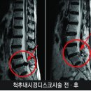 척추치료 - 척추내시경레이저시술 이미지