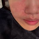 맥스샤인 | 구월동피부과 리쥬란 맥스 더마샤인 솔직 후기