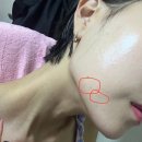 강남-011 | 손유나클리닉 매직캣주사 받고 온 리얼후기 – 윤곽라인 1회차 받고 난 변화