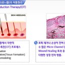 ＜닥터포유 피부치료＞ - 닥터포유의 MTS 시술이 좋은 이유는? 이미지