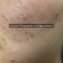 사계절에스한의원 | 내돈내산 :: 스킨앤랩 하이베리어 히알루로닉 에센스, 크림, 베리어덤 밀키 세럼 찐 사용후기(정착템)