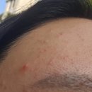 인생약국 | 좁쌀여드름 클리어틴 vs 애크린겔 직접 비교 후기 (가격·효과·약국)