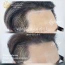 하이스칼프 이미지