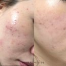 플랜유의원 | [W_03] 웨딩촬영 전 피부관리 feat.주사피부염 현재 근황일기 분노의 염증주사