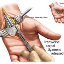 손목 터널 증후군 이미지