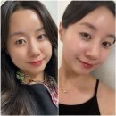 강남역데이원의원 | 데이원 강남역점 내돈내산 이중턱 고민 해결 티타늄리프팅