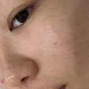 상무지구 피부과 리투오 스킨부스터 + 피코프락셀 왕모공쟁이 후기