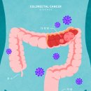 [헬스S] 폐암·간암에 이은 '암 사망 3위' 예방은 이미지