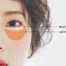 눈밑지방재배치 성형외과 발품 상담 7곳 후기