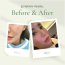 양실장피부관리실 | 압구정피부과에서 리쥬란맥스 맞고 피부에서 광이나요 :)