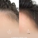 지워지는 두피문신? 소레아 시술 솔직후기! (아인뷰티랩 마곡점)