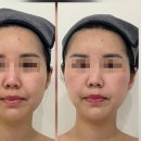 세종이마트 믿음약국 | 세종피부관리 연에스테틱 리프팅관리 후기