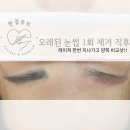 한결 | 안산 눈썹문신제거 일상생활가능/후기 많은샵 -한결뷰티-
