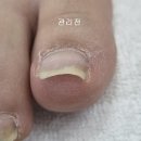 킴스네일 - 안동시 경북대로 418 | 여름철 내성발톱 통증 걱정 끝! 2026년 광주 동구 킴스네일 교정 후기