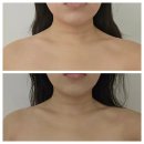 중로(보)1-1-2 | 대구 신부관리 내돈내산 유에보에스테틱 윤곽관리 후기