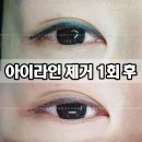 2089 | 남양주 아이라인제거 잘하는곳 ! 반영구제거 잘하는 곳 ~ 후기정리~