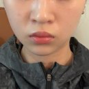얼굴라인 정리에 좋은 청담역 피부과 티타늄80kj 다운타임 솔직후기