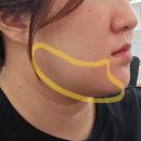 미의여신 - 북구 설죽로 419 | 송도 피부과에서 심부볼, 이중턱 해결! 미글로우리프팅 후기! (온다 리프팅 비교)