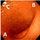 duodenal SDA [ sup. duodenal angle] 이미지