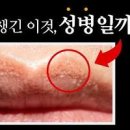 입술 헤르페스 원인 수포 구순포진 입술 물집 이미지