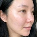 영레이저 | 올리브영 EGF 재생크림 레이저 시술후 추천 후기