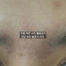 (주)인터파마 | 에크린겔 사용법 부작용 좁쌀여드름 연고로 없애기 실패 후기