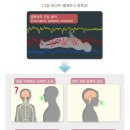뇌전증이 수반된 후천성 실어증(失語症)[란다우-클레프너] (F80.3) 이미지