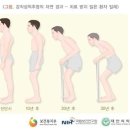 강직성 척추염[ ankylosing spondylitis ] 은 ? 이미지