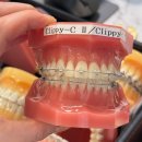 서울대입구 5번출구 | 서울대입구역 치과 돌출입 치아교정 상담 비용 솔직후기