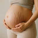 (주)바이오메디 | 튼살크림,바이오필링 튼살관리 어느것을 하면 좋을까? 동천동 MS에스테틱관리법,후기,홈케어방법