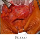 몸속 시한폭탄 대동맥류~~꼭 읽어보세요 이미지