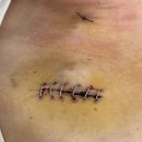 천호기내과의원 | 30대 유방암 기록 #3 유방암 수술 후 최종 병기 확인 후 항암 결정(feat. 발진)