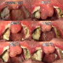 편도수술 8일차 후기 찌러왔읍니다 ( 줄 글 주 의 ) 이미지