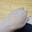 동의보감한의원 | 일산 주엽역 한의원 추천, 손목 삐었을 때 사암침법 백광훈한의원 2일 치료 후기