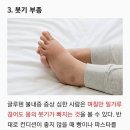 글루텐 불내증 증상 7가지 이미지