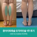 조각성형외과의원 | 얀클리닉 종아리퇴축술 + 또각라인술 내돈내산 1주차 솔직 후기｜멍·통증·변화까지