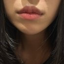 돈신사 | 신사입술필러후기 : 내돈시술 솔직 후기 !